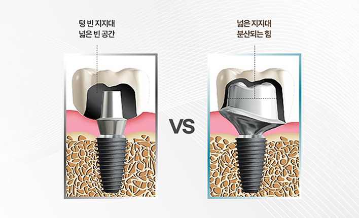 맞춤형 지대주로 완성하는 심미와 기능